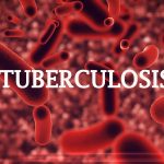 Tuberculosis-1